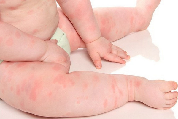 Аллергия у малыша, симптомы, лечение.