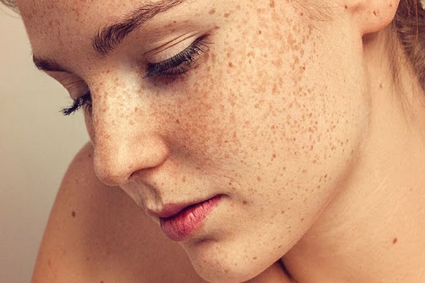 Гиперпигментация кожи – что это такое?