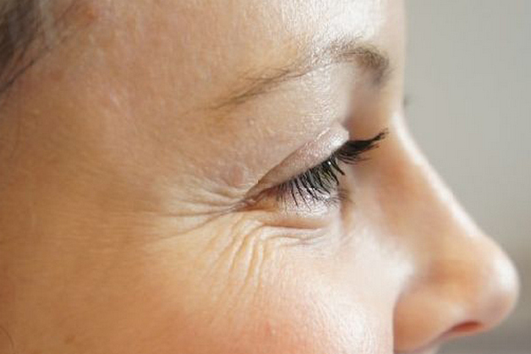 Почему образуются морщинки около глаз?