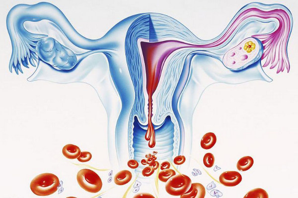 Дисфункциональные маточные кровотечения, фибромиома матки с геморрагическим синдромом