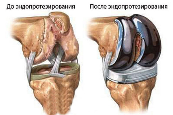 Эндопротезирование коленного сустава