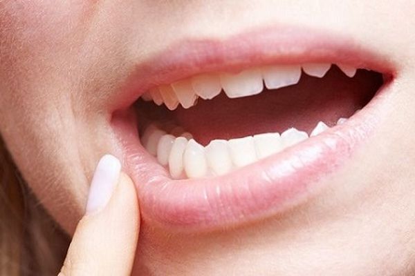 Все об отбеливании зубов в стоматологии