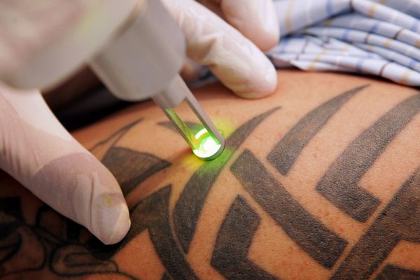 Лазеры для удаления тату