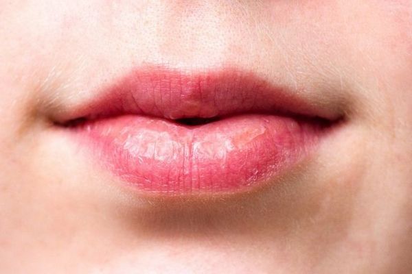 Что поможет убрать трещины на губах?