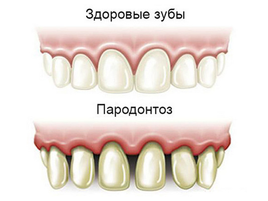 Чем лечить пародонтит?