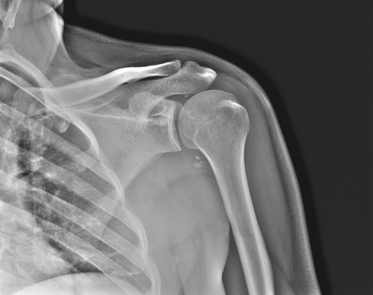 МРТ плечевого сустава: что показывает?