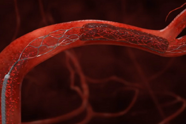 Как анемия провоцирует инсульт