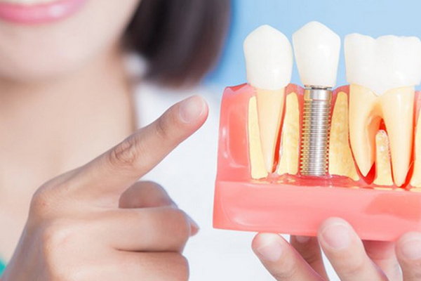 Сроки службы различных зубных имплантов