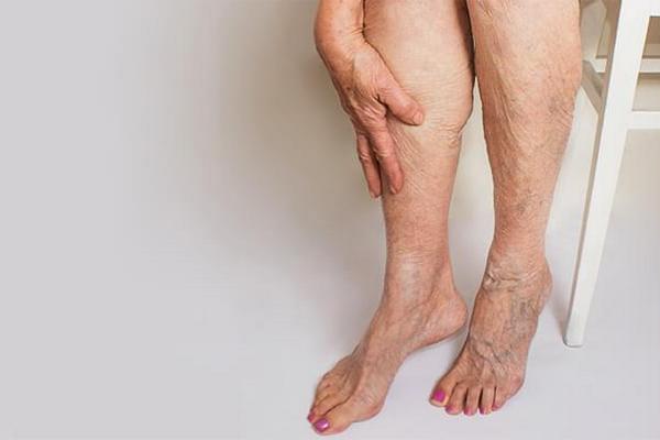 Отек и боль в ноге: 5 ключевых симптомов тромбоза глубоких вен (ТГВ) и мозговых синусов