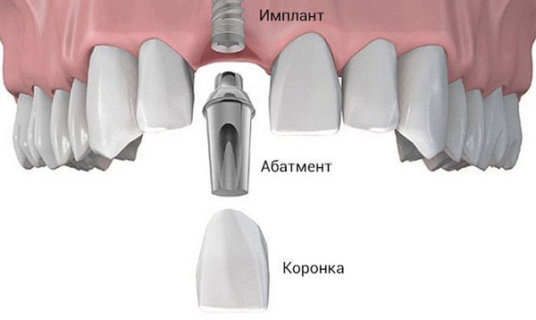 Имплантация зубов