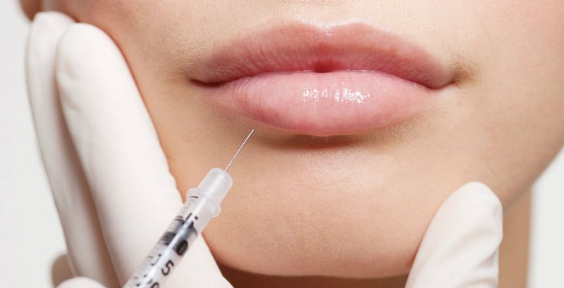 Что нужно знать об увеличении губ гиалуроновой кислотой