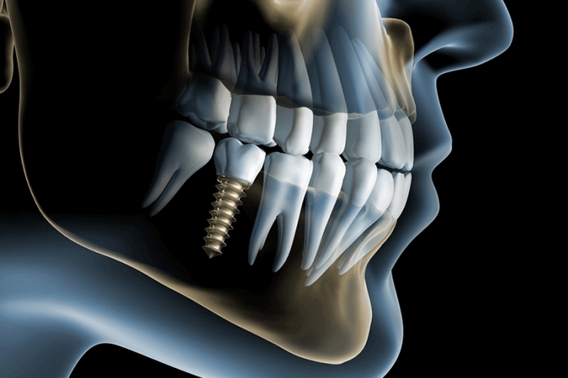 Базальная имплантация - новый и эффективный способ протезирования зубов