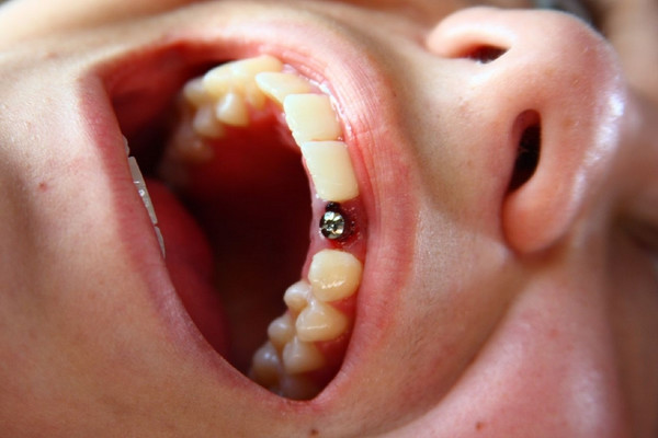 Безболезненная имплантация зубов