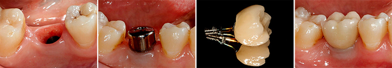 Имплантация зубов