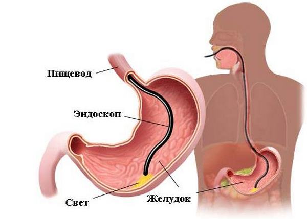 Гастроскопия