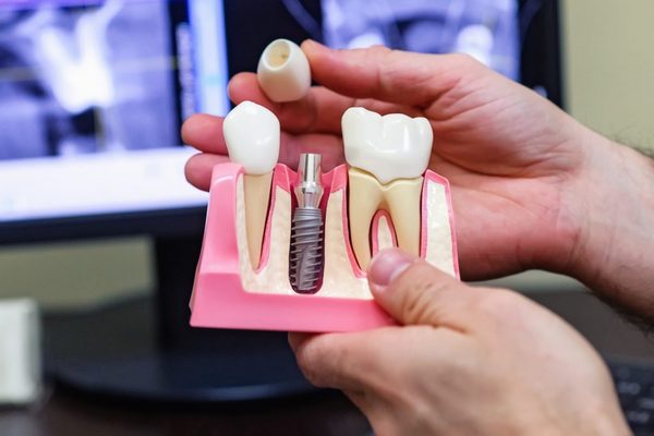 Почему зубные имплантаты на первом месте?