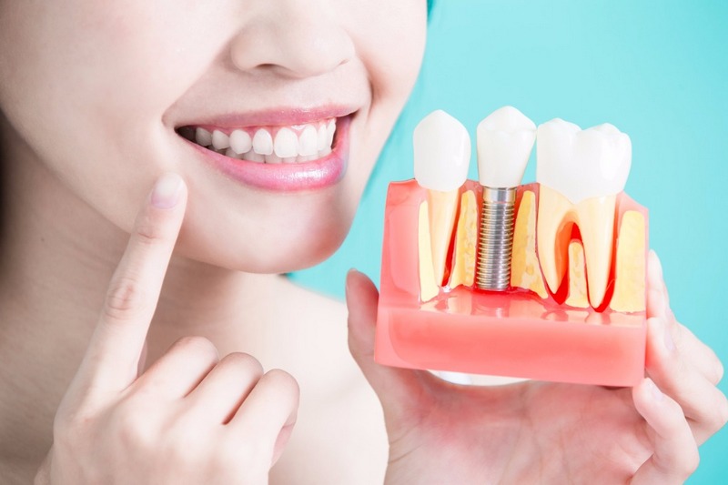 Стоит ли бояться имплантации зубов?