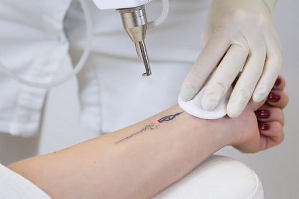 Через какое время после удаления тату лазером можно делать новую татуи