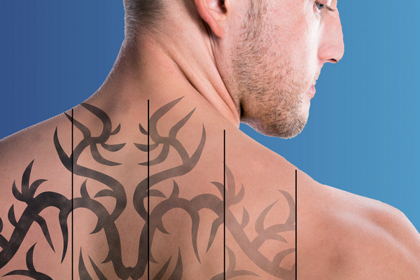 Через какое время после удаления тату лазером можно делать новую татуировку